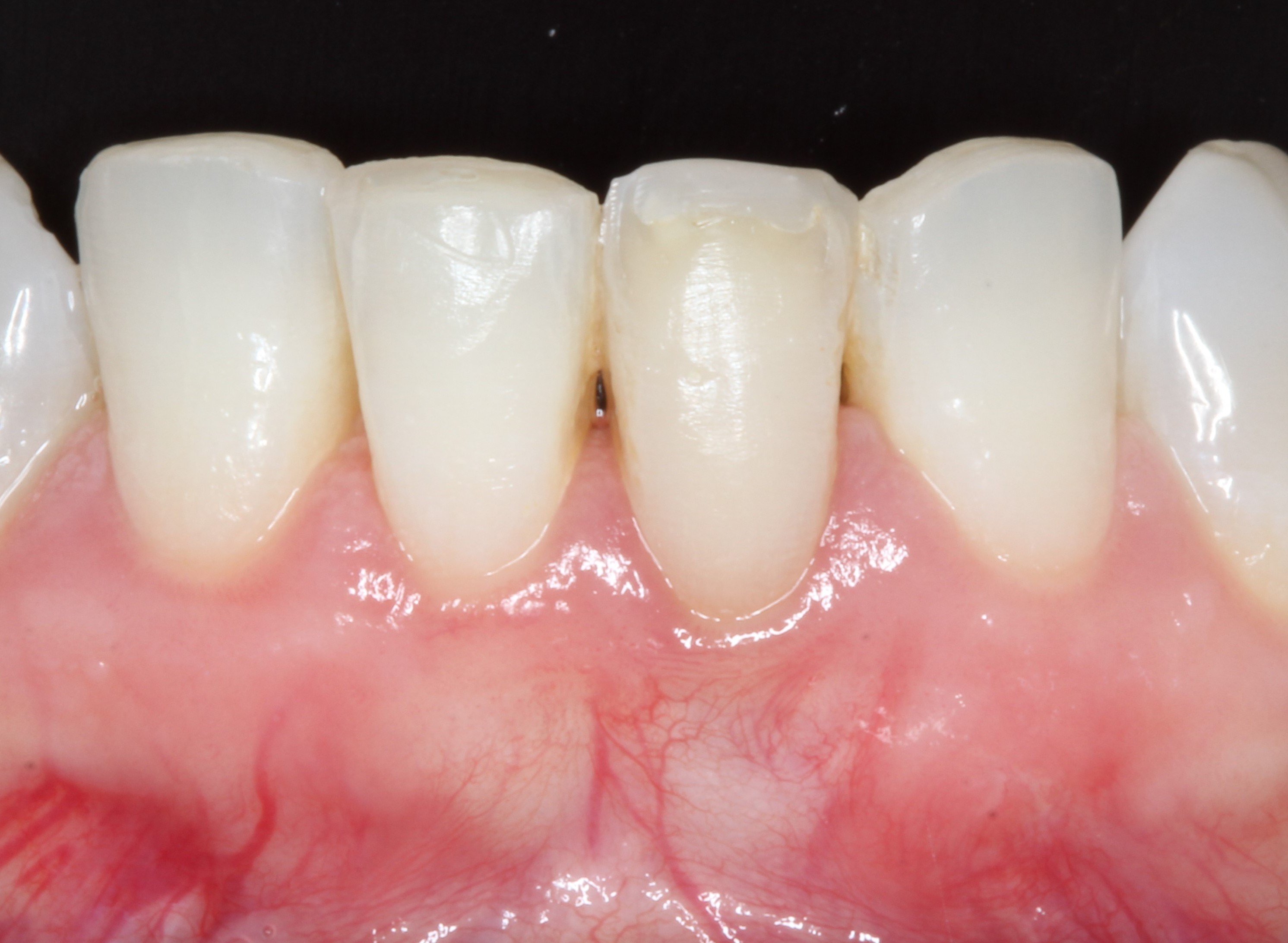 Post-tratamiento Tratamientos de periodoncia