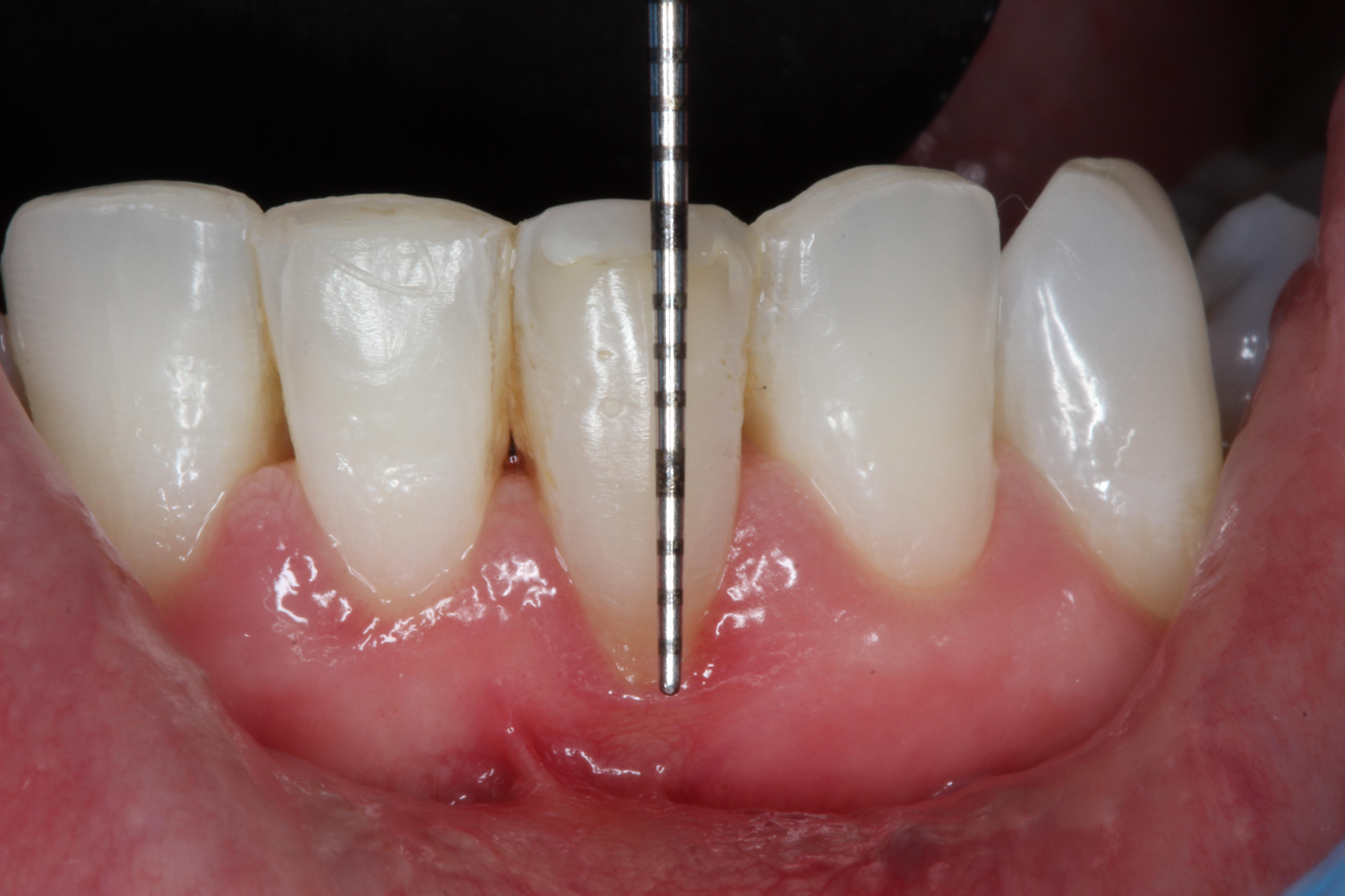 Pre-tratamiento Tratamientos de periodoncia