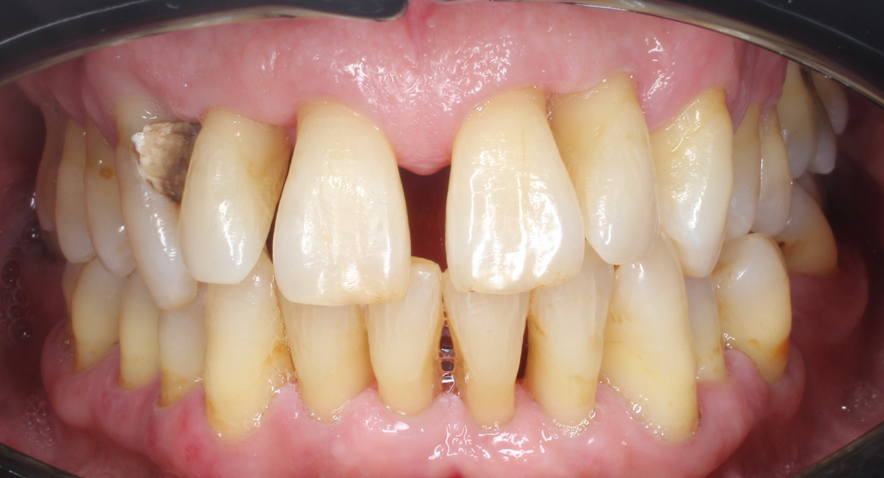 Post-tratamiento Tratamientos de periodoncia