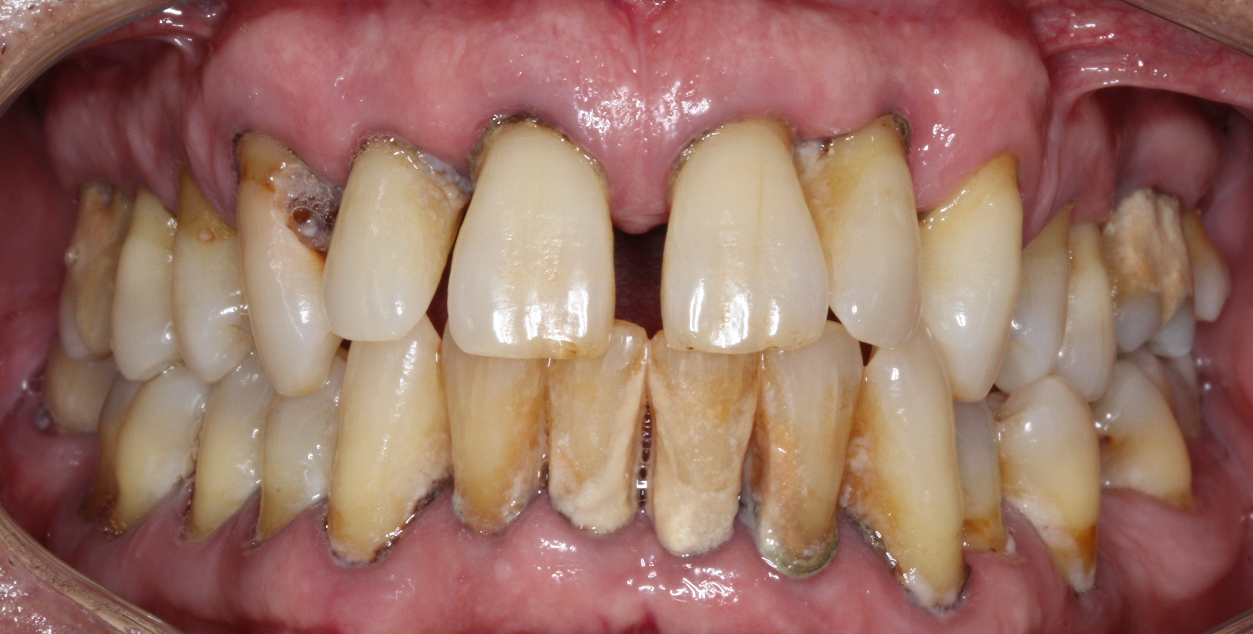 Pre-tratamiento Tratamientos de periodoncia