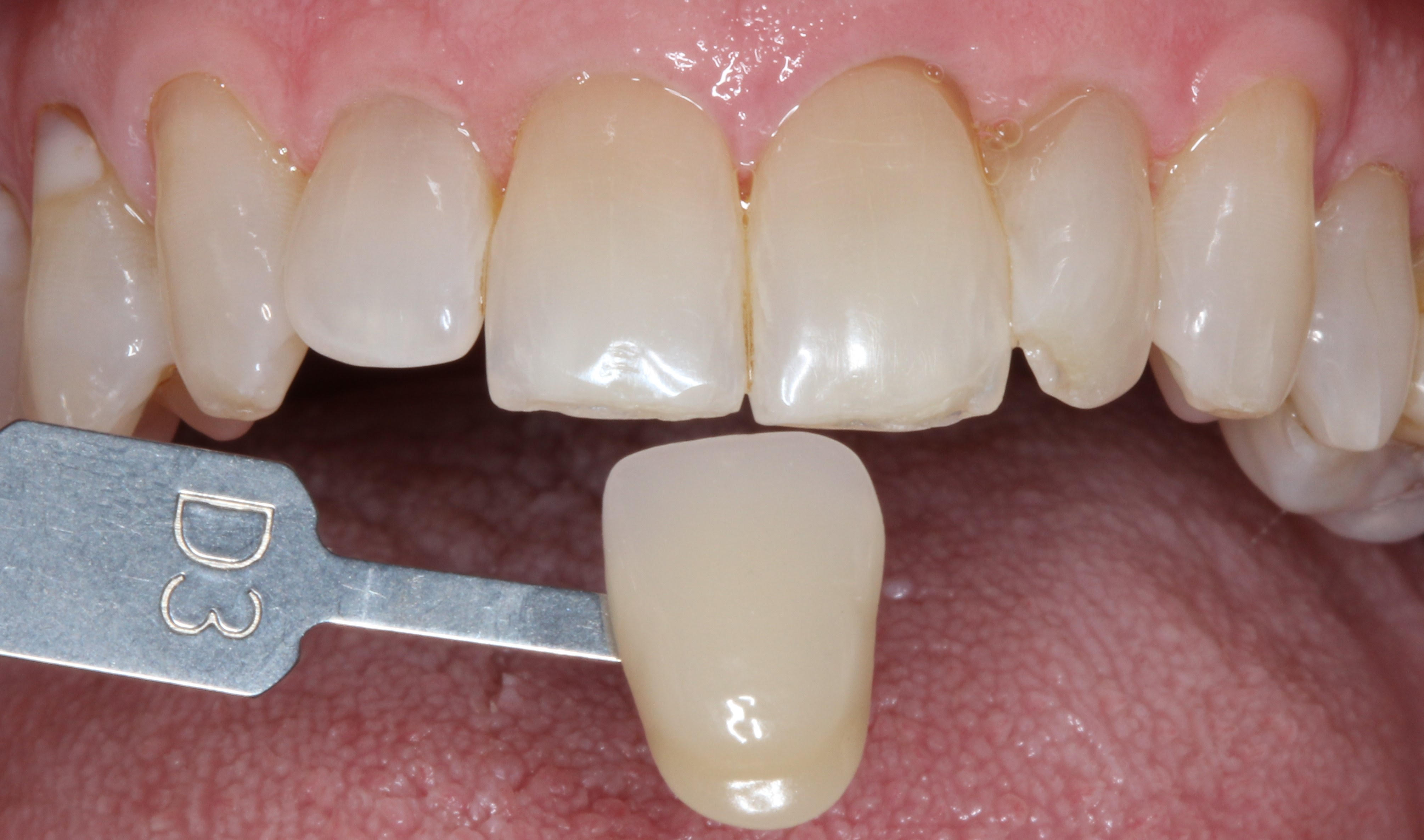 Pre-tratamiento Blanqueamiento dental