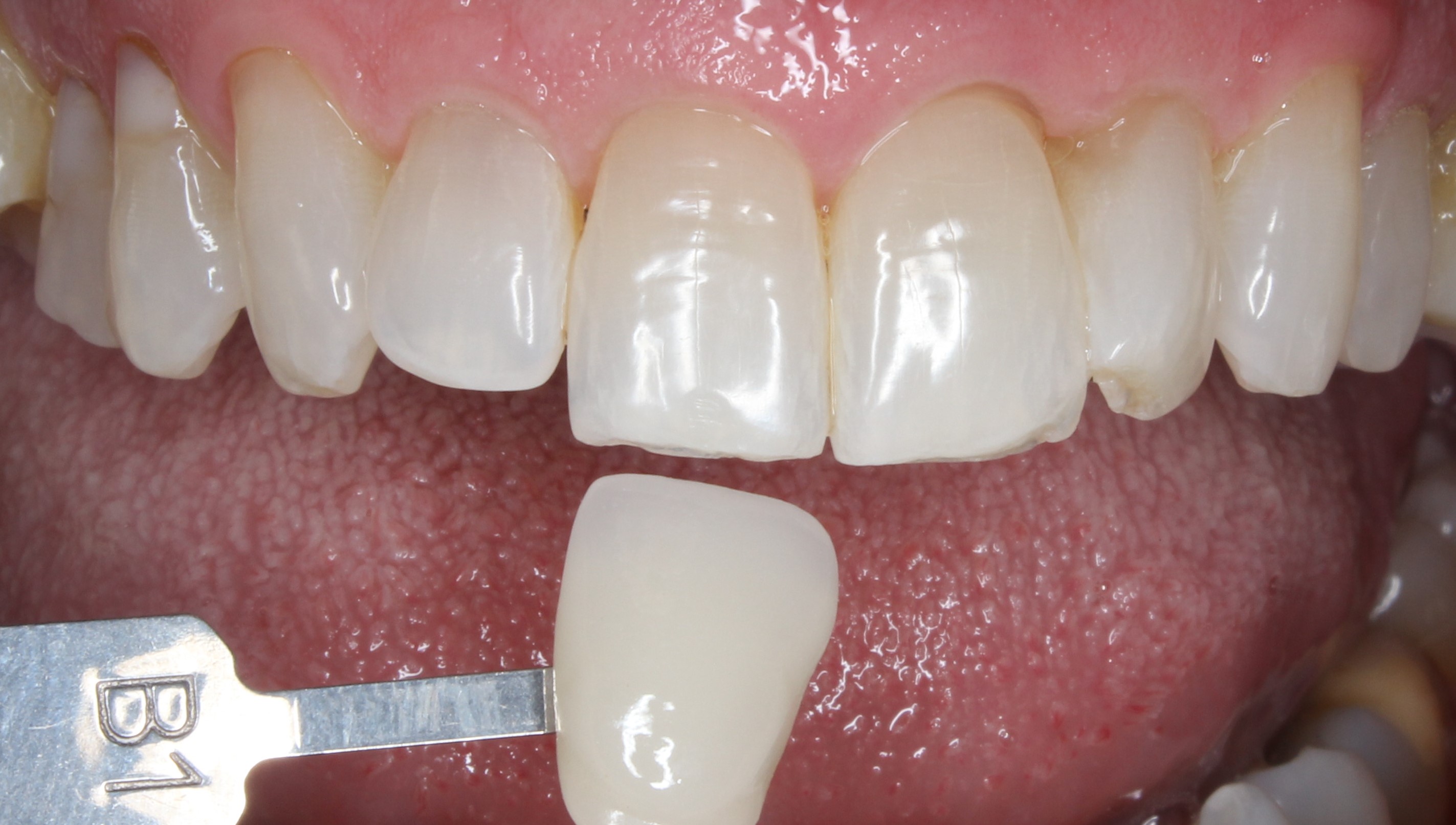 Post-tratamiento Blanqueamiento dental