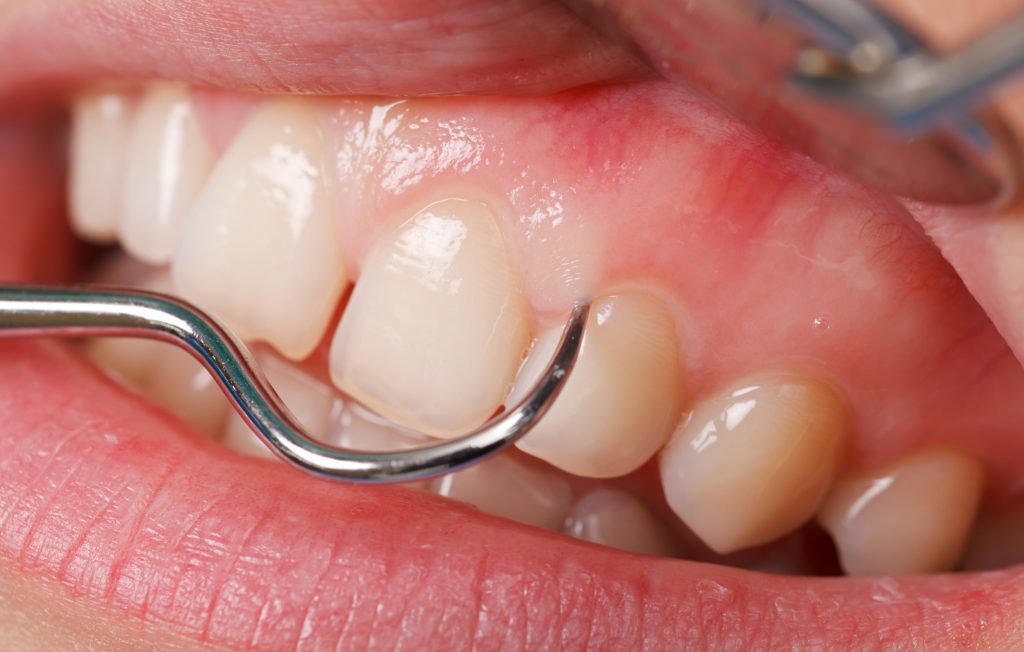 Periodontitis- Clínica dental Belén Pérez