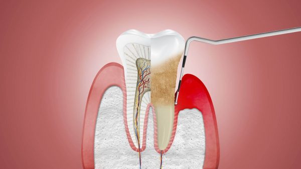 Tratamiento de periodontitis en la clínica dental Belén Pérez en Getxo
