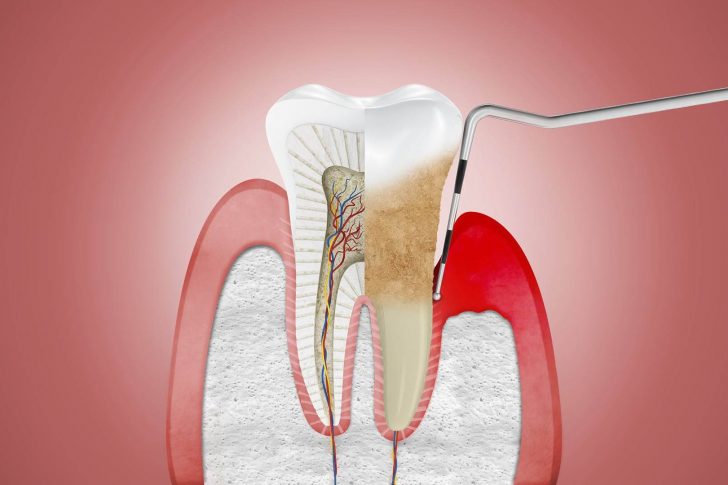 Tratamiento de periodontitis en la clínica dental Belén Pérez en Getxo