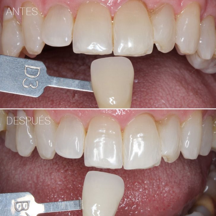 Casos clínicos Belén Pérez dentista en Getxo