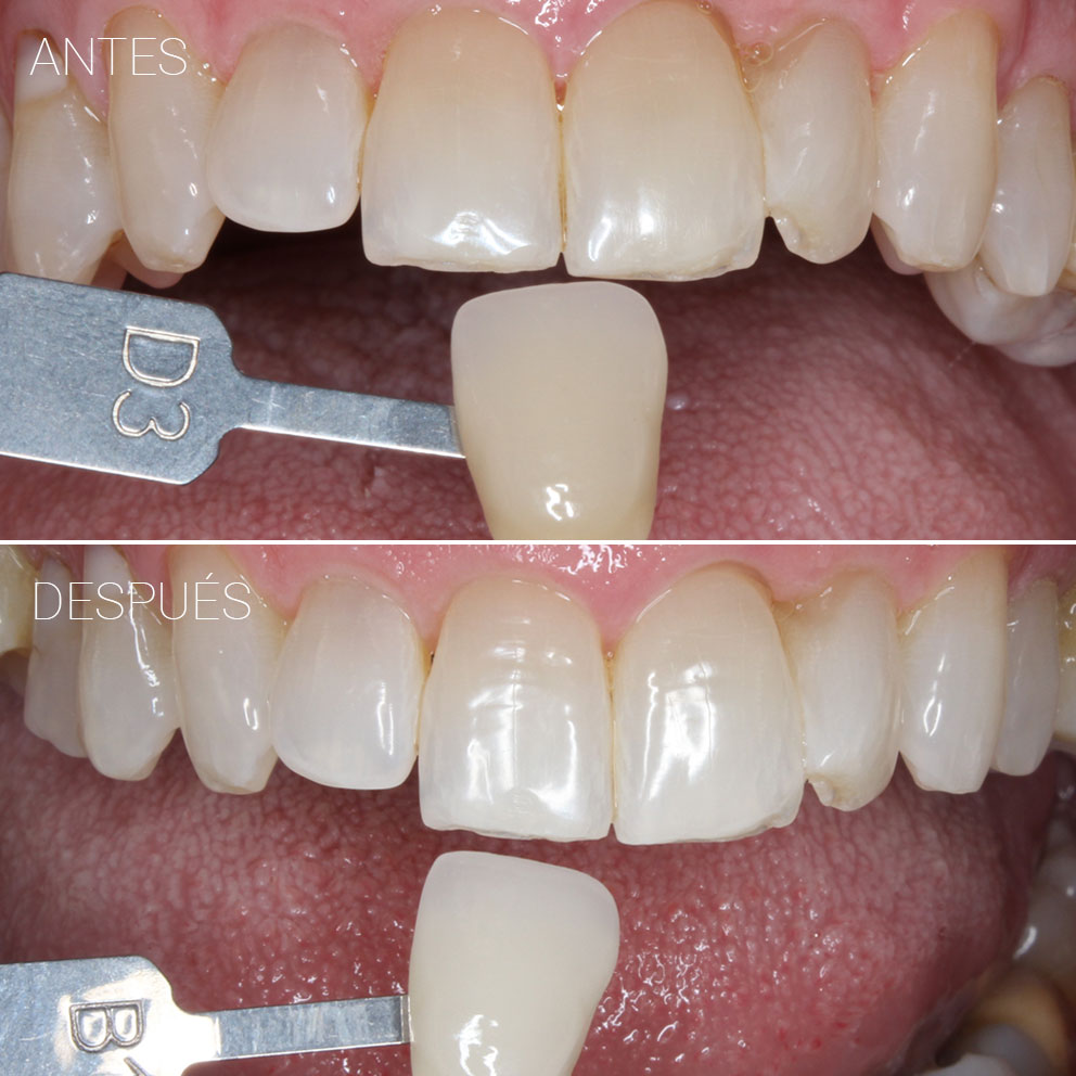 Casos clínicos Belén Pérez dentista en Getxo