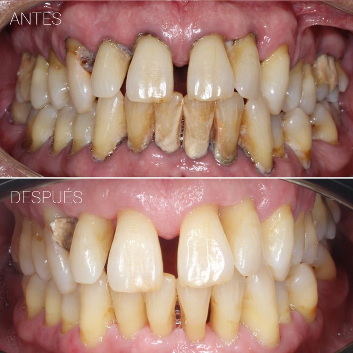 Casos clínicos Belén Pérez clínica dental en Getxo