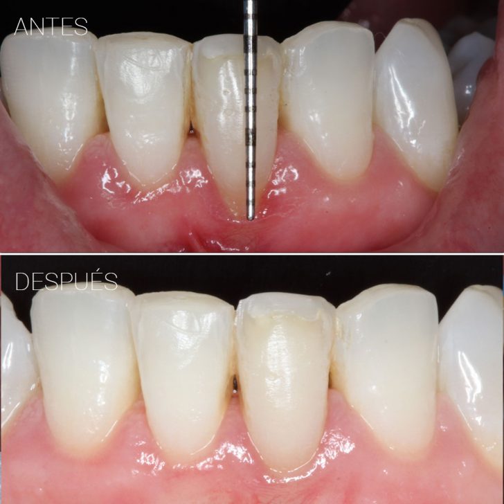 Casos clínicos clínica dental en Getxo Belén Pérez