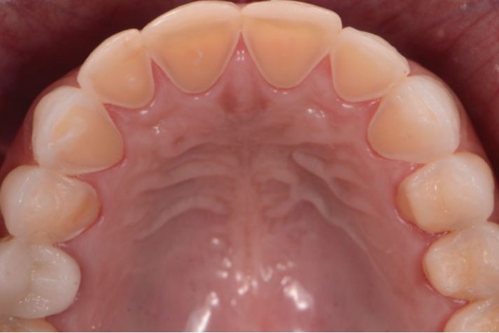 ¿Qué es la erosión dental?
