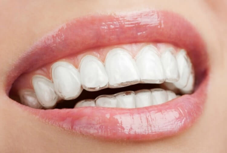 Blanqueamiento dental en casa con funda
