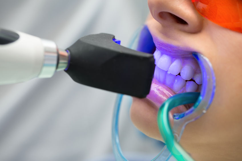 Blanqueamiento dental con luz LED