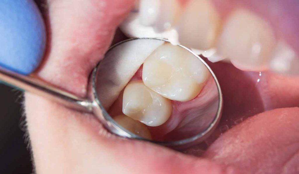pulpitis reversible - Belen Perez, clinica dental Getxo