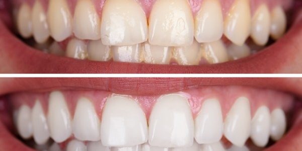 tipos de blanqueamiento dental en casa