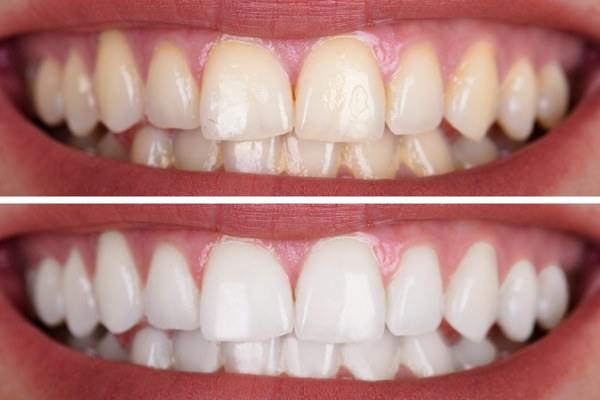 tipos de blanqueamiento dental en casa