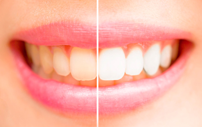 tipos de blanqueamiento dental