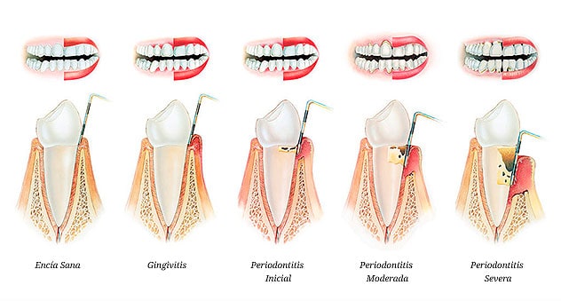 Fases de la enfermedad peridontal - Belén Pérez dentista