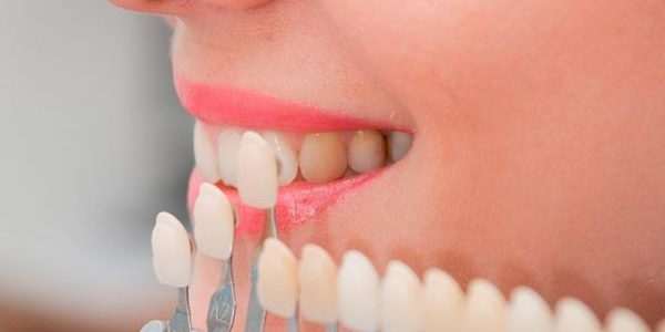 Distintas carillas dentales en un blanqueamiento - Belén Pérez, clínica dental Getxo