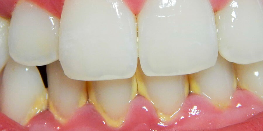 Dientes con sarro. Especialmente los dientes de abajo.