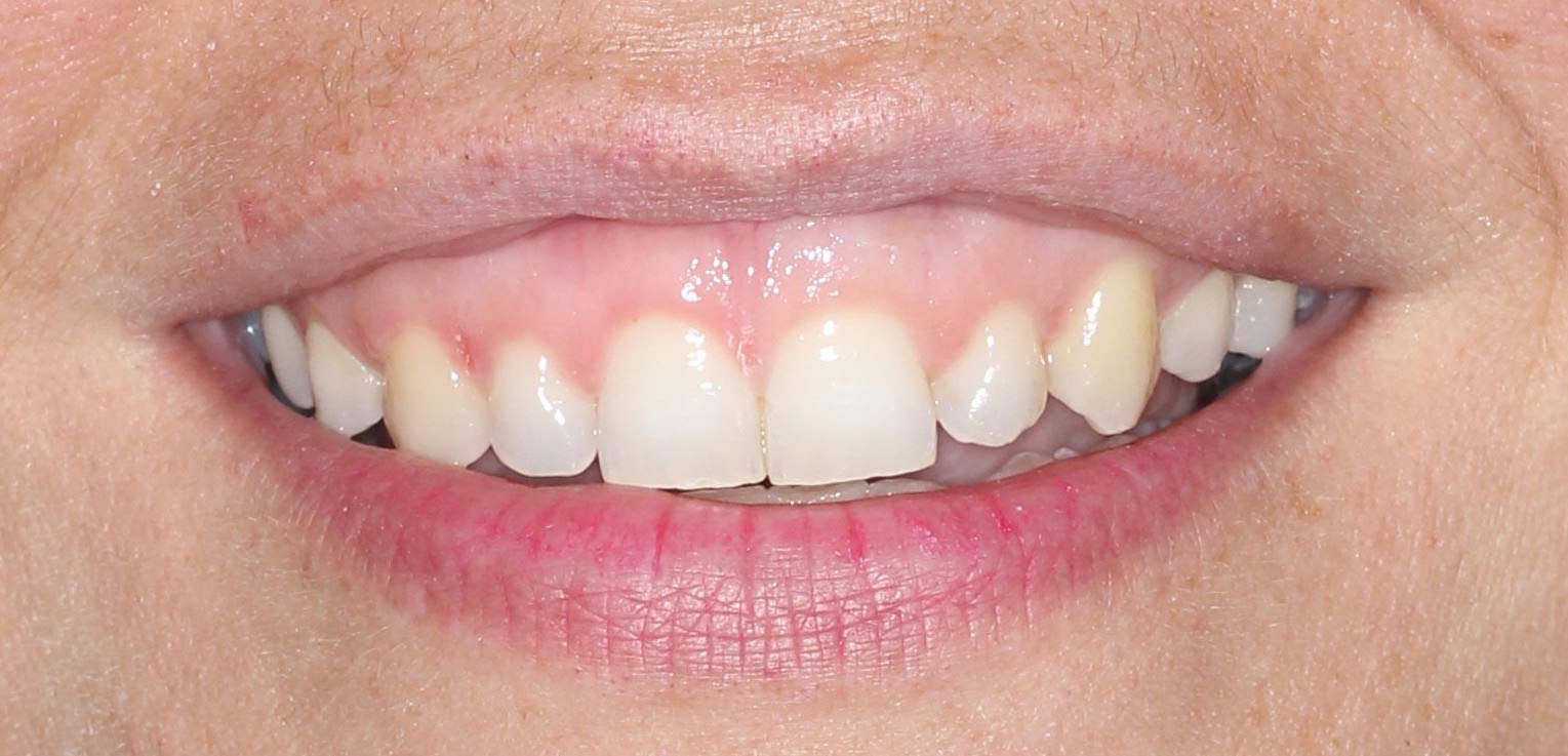 pre-tratamiento tratamiento de alargamiento de corona dental estética