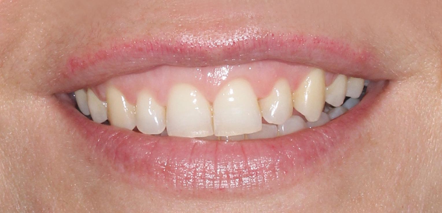 post-tratamiento alargamiento de corona dental en getxo