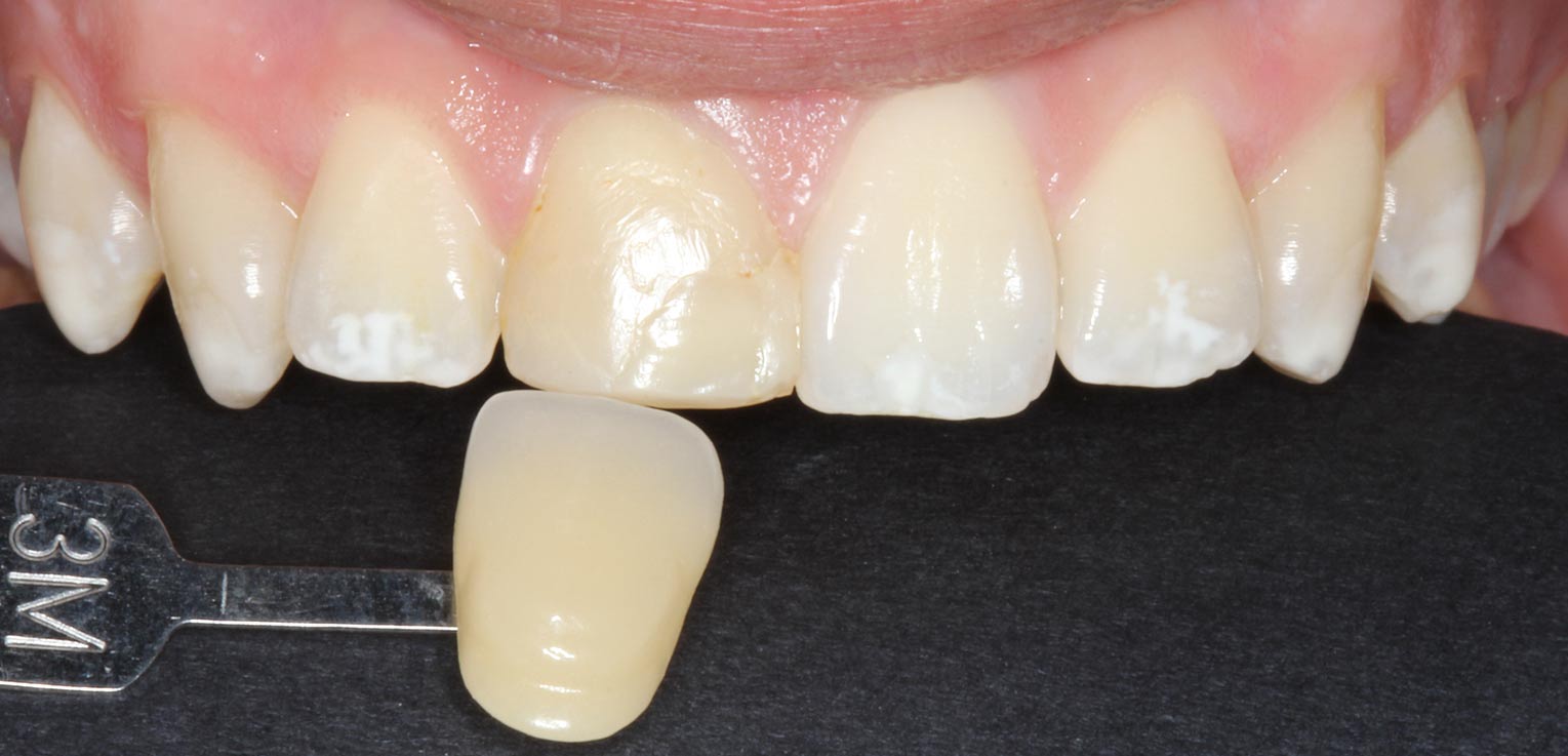 pre-tratamiento reconstruccion dental con composite