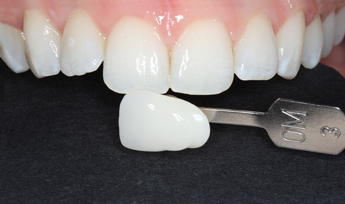post-tratamiento blanqueamiento dental externo domicialiario en getxo