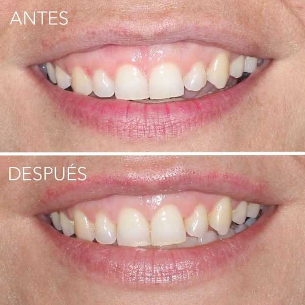 tratamiento de alargamiento de corona dental periodocia en getxo
