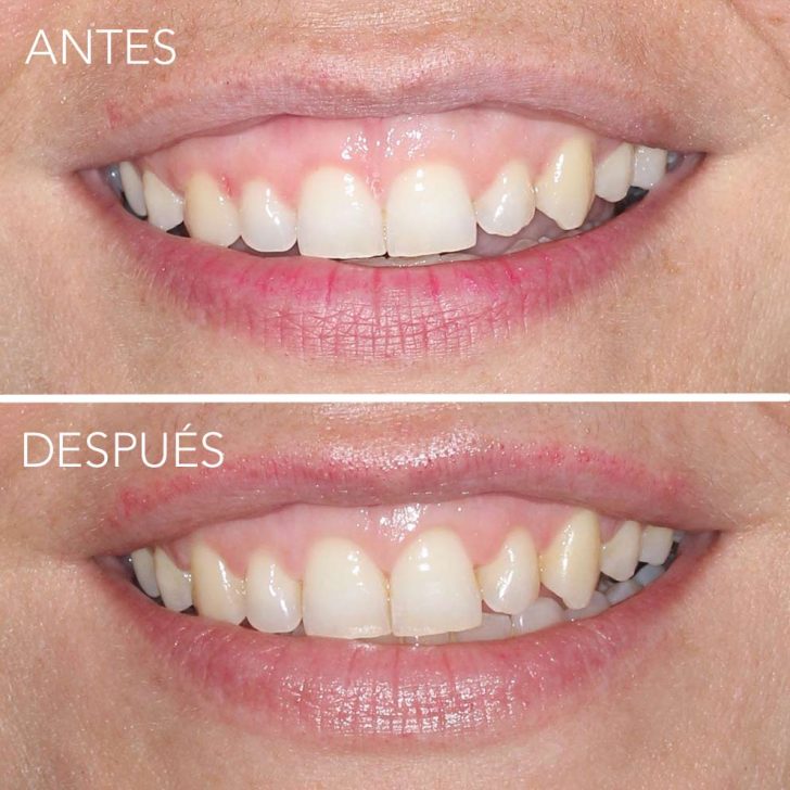 tratamiento de alargamiento de corona dental periodocia en getxo
