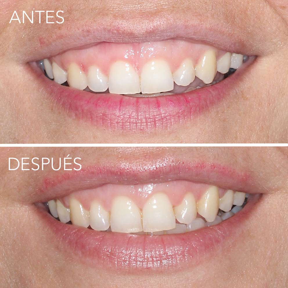 tratamiento de alargamiento de corona dental periodocia en getxo