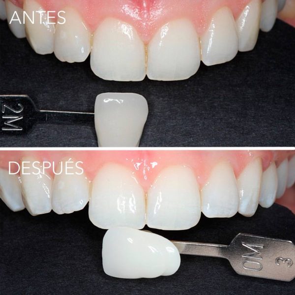 blanqueamiento dental en getxo