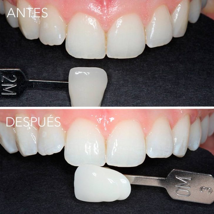 blanqueamiento dental en getxo