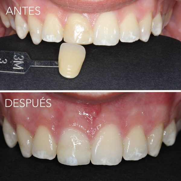 reconstruccion dental en getxo