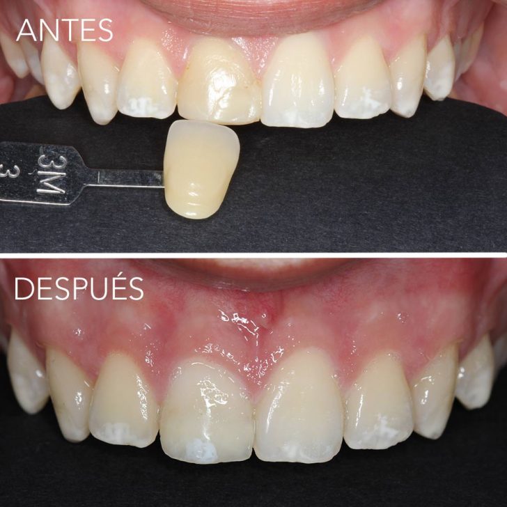 reconstruccion dental en getxo