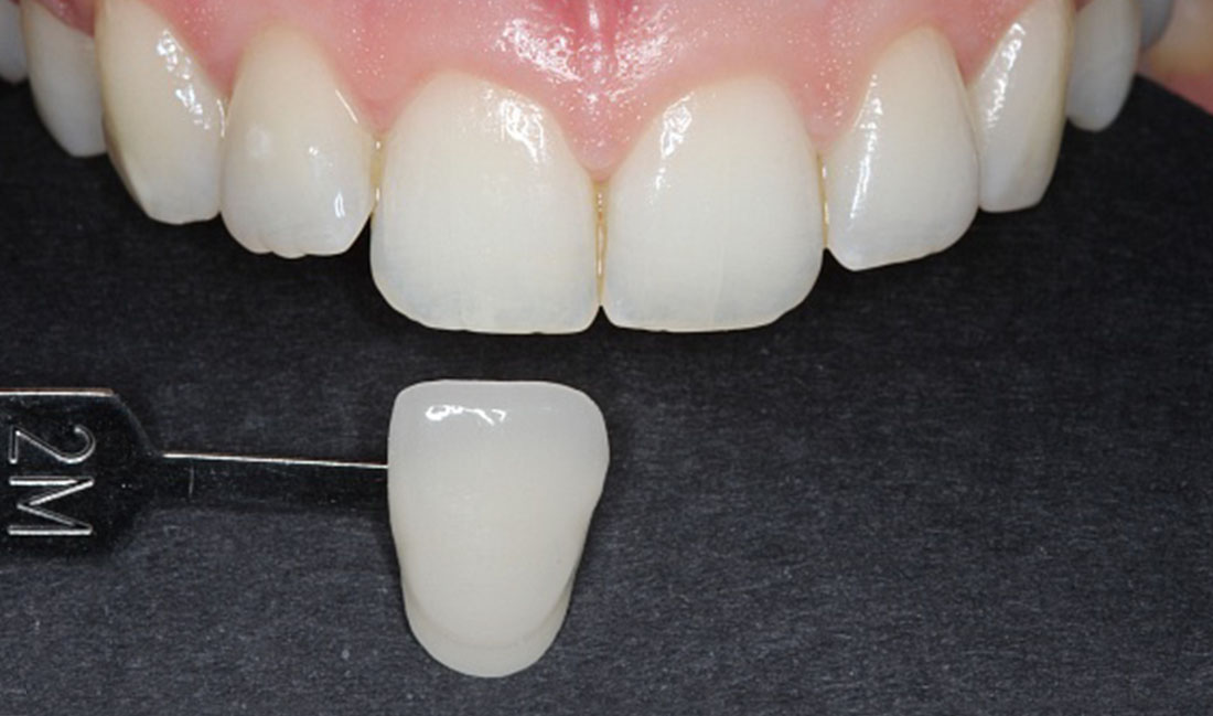 pre-tratamiento tratamiento de blanqueamiento dental en getxo