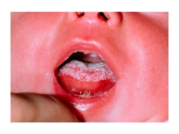 candidiasis bucal en bebés
