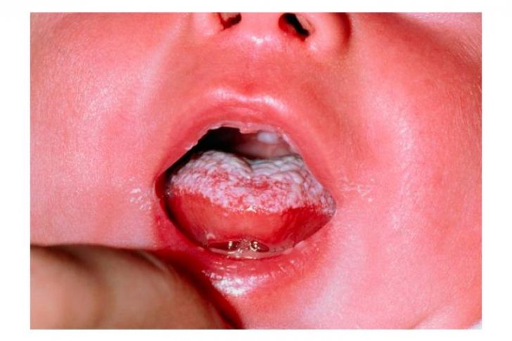 candidiasis bucal en bebés