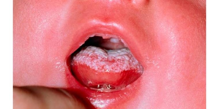 candidiasis bucal en bebés