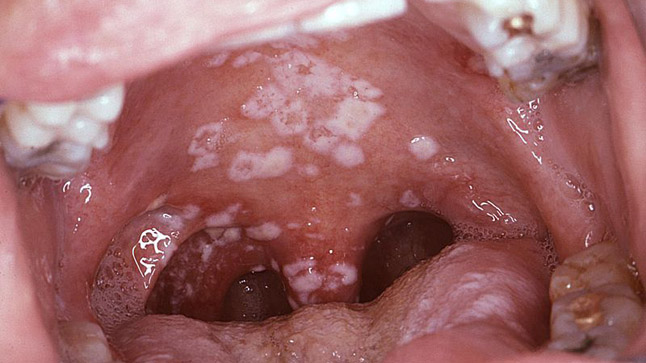candidiasis bucal manchas