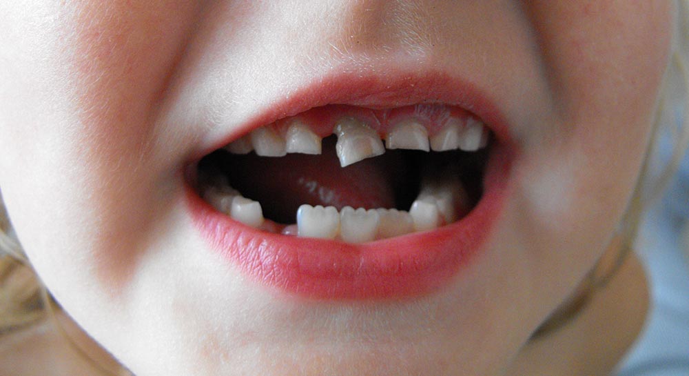 qué es un traumatismo dental