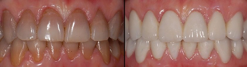 causas y tratamientos de los dientes oscurecidos