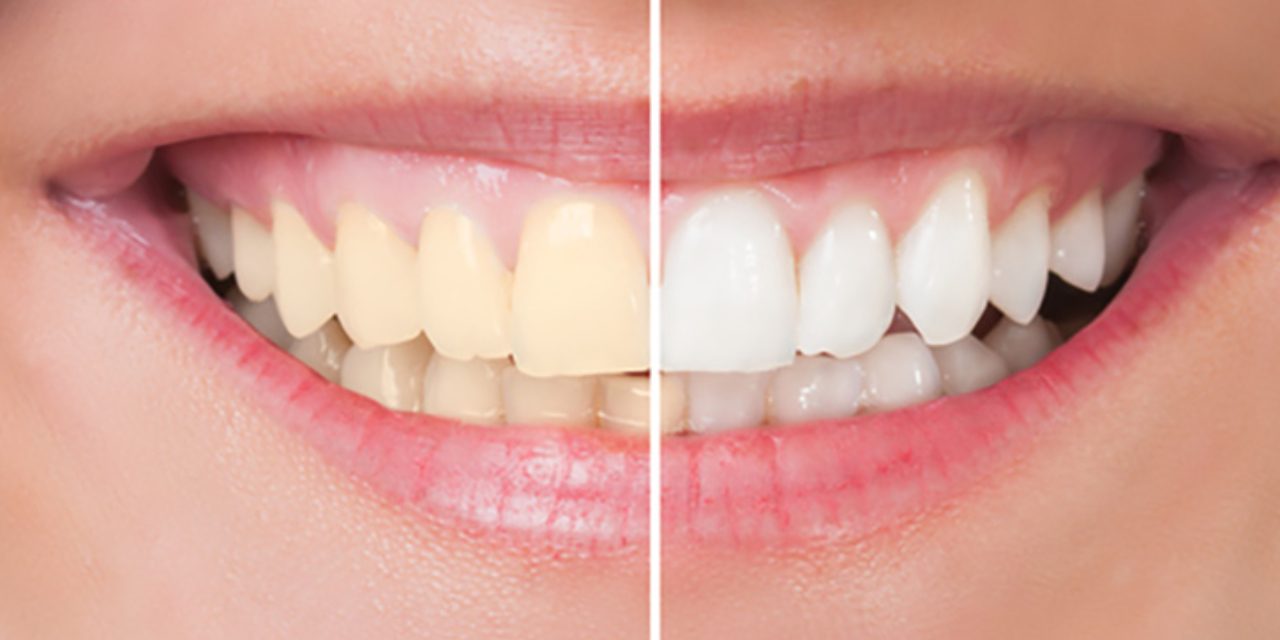 qué son los dientes oscurecidos