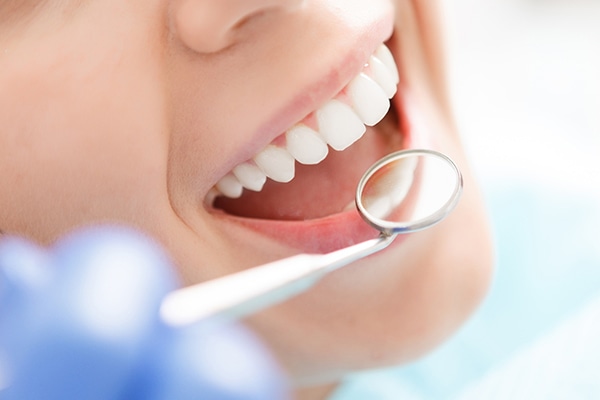 Qué es la gingivitis - Belén Pérez Clínica dental Getxo