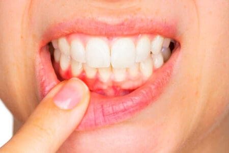 Diferencia entre periodontitis y gingivitis - Belén Pérez, clínica dental en Getxo