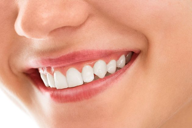 qué es la gingivitis - Gingivectomía