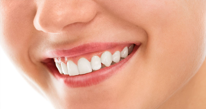 qué es la gingivitis - Gingivectomía