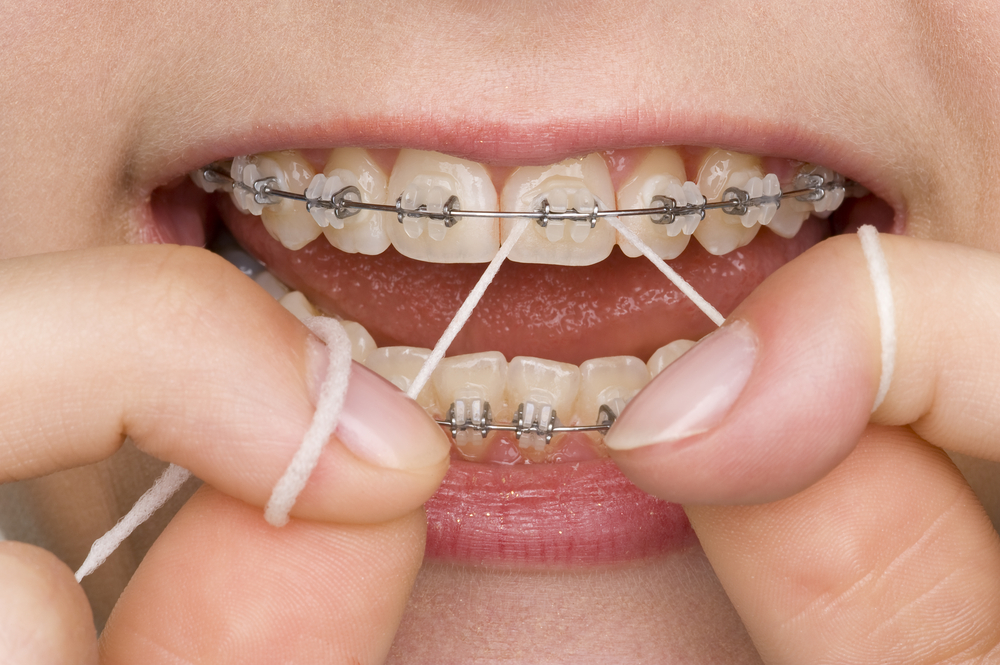 limpieza dental brackets
