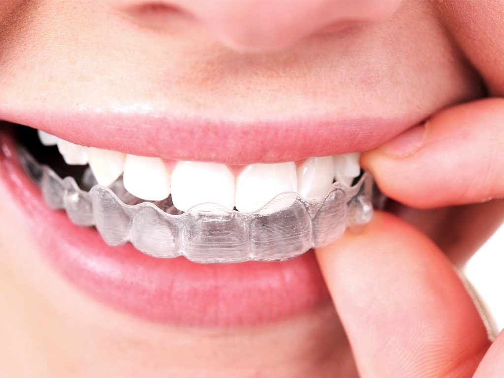 Cuidados de los dientes con ortodoncia