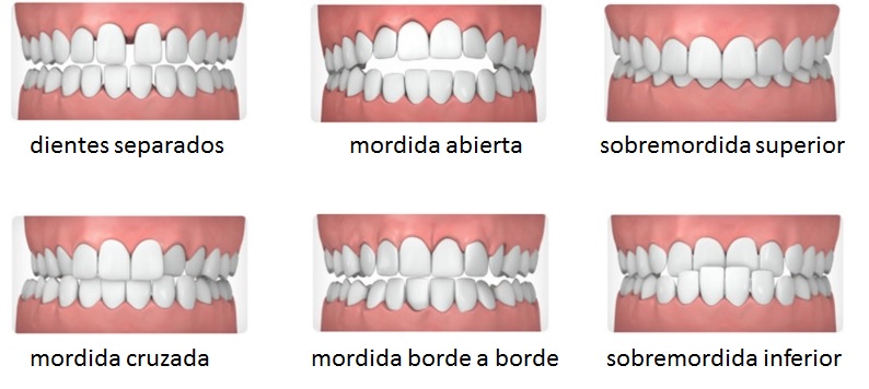 Tipos de maloclusión dental