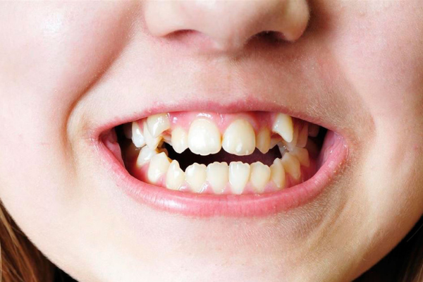 La maloclusión dental